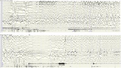 Video-electroencephalographic findings and clinical characteristics of bathing seizures in children